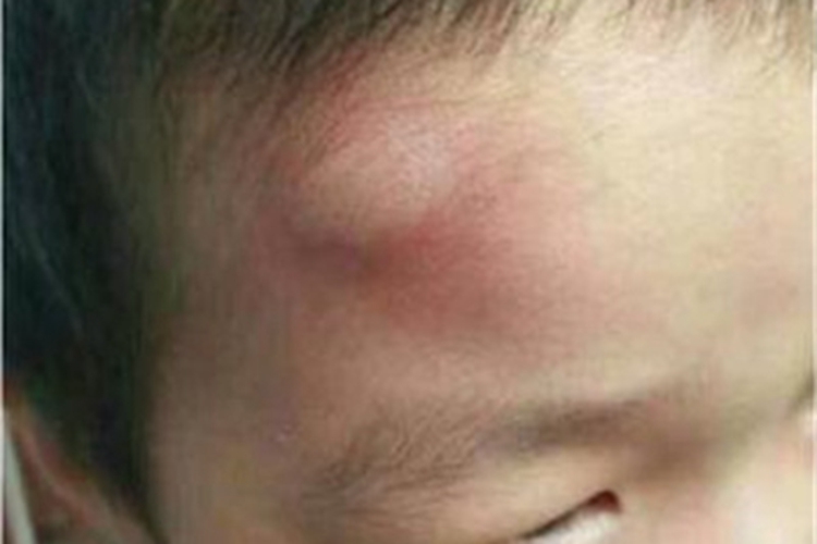 蚊子叮咬及引起的皮肤反应大包图