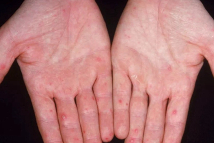 1级手足综合征手部红斑图
