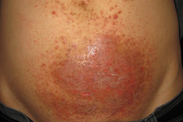 色素性痒疹腹部结痂图 色素性痒疹腹部结痂图