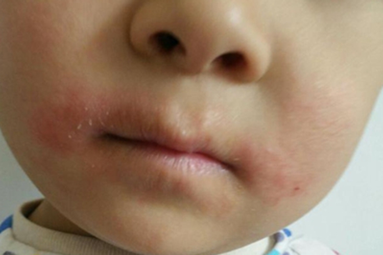 维生素B2缺乏症口周症状图