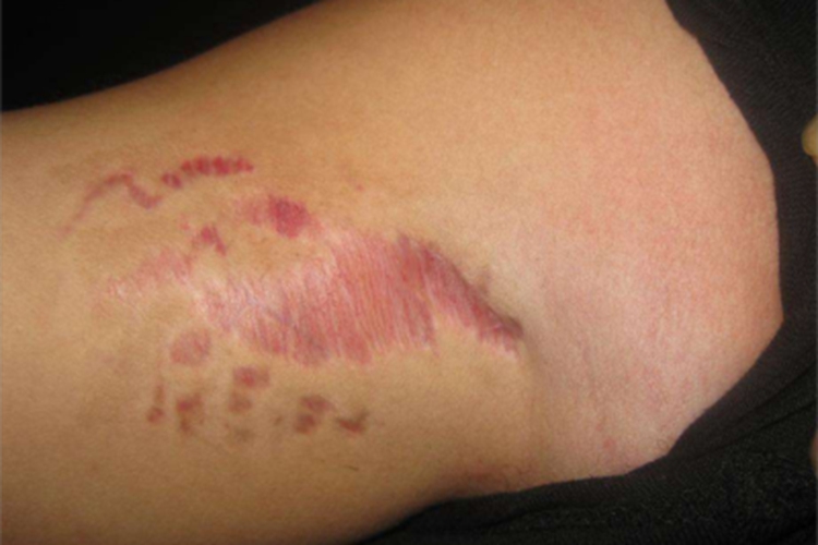 继发性斑状萎缩大腿皮肤萎缩图