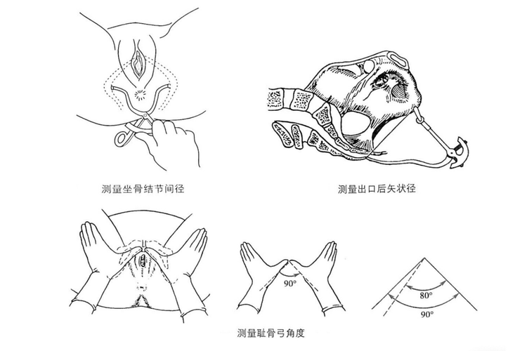 坐骨结节间径、出口后矢状径、耻骨弓角度测量图