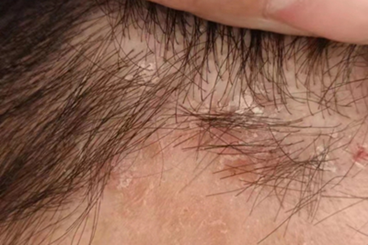 寻常型银屑病头皮脱屑图