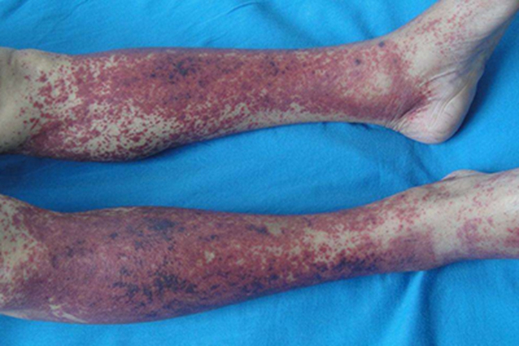 过敏性紫癜小腿发紫发黑图