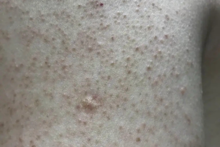 毛囊性鱼鳞病背部症状图