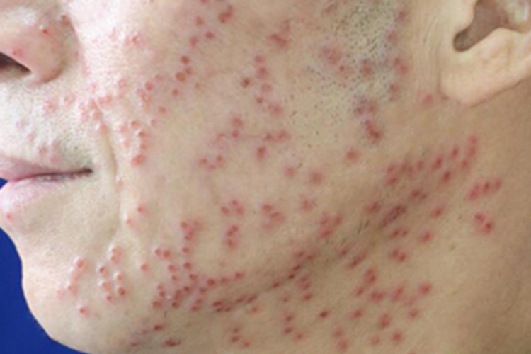 疱疹样湿疹面部小水疱图 疱疹样湿疹面部小水疱图