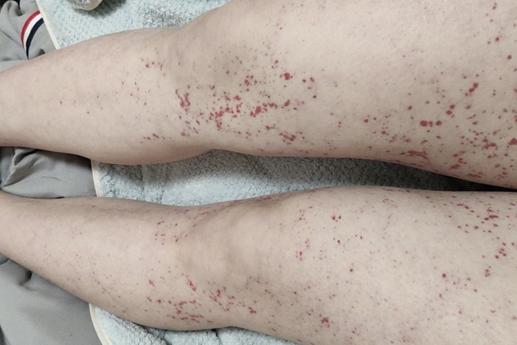 大腿内侧过敏性紫癜图