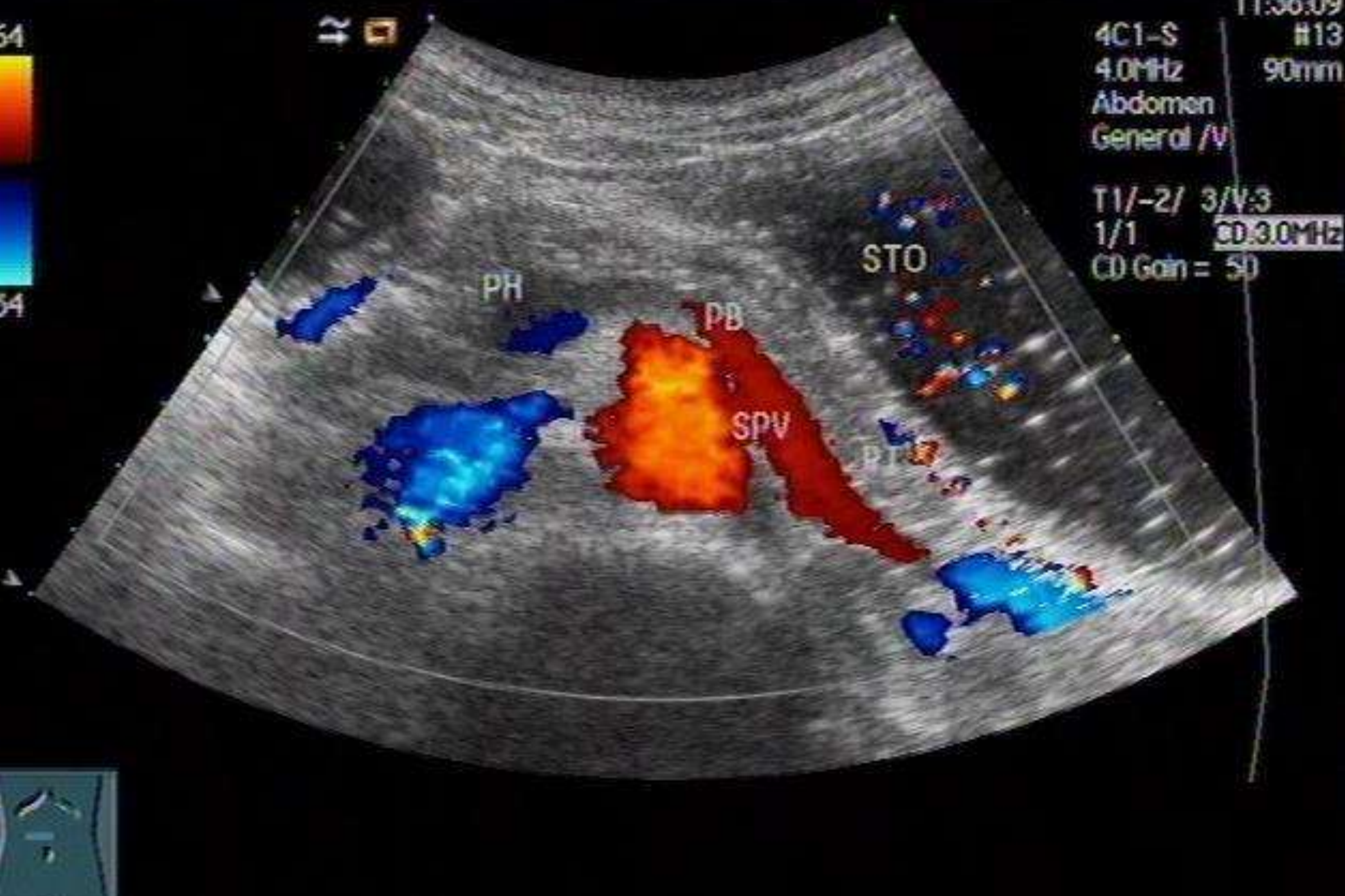 正常胰腺声像图 正常胰腺声像图