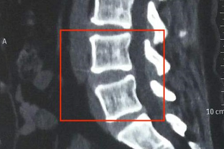 脊椎L4L5正常CT图