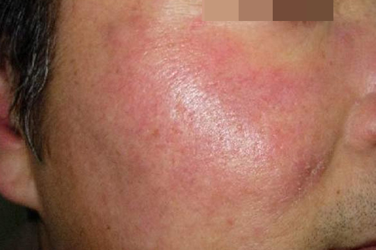 面部接触性皮炎图