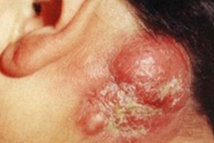 皮脂腺癌脖子长大红包图