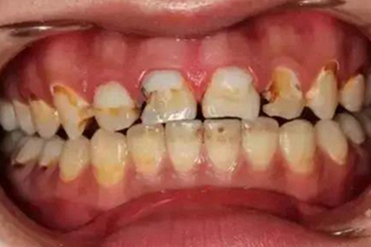 酸蚀症牙齿多处黄斑图
