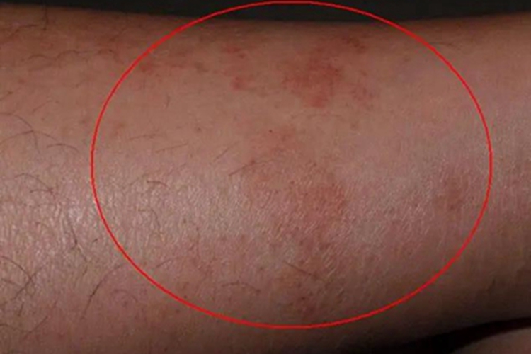 干性湿疹小腿上有几处红斑图