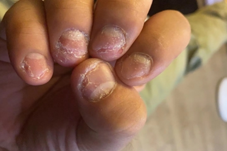 全甲损毁型甲真菌病手指甲缩小图