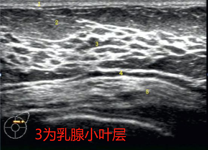 乳腺小叶超声下位置图 乳腺小叶超声下位置图