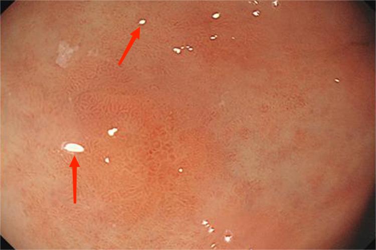 瓷白色小结节型图