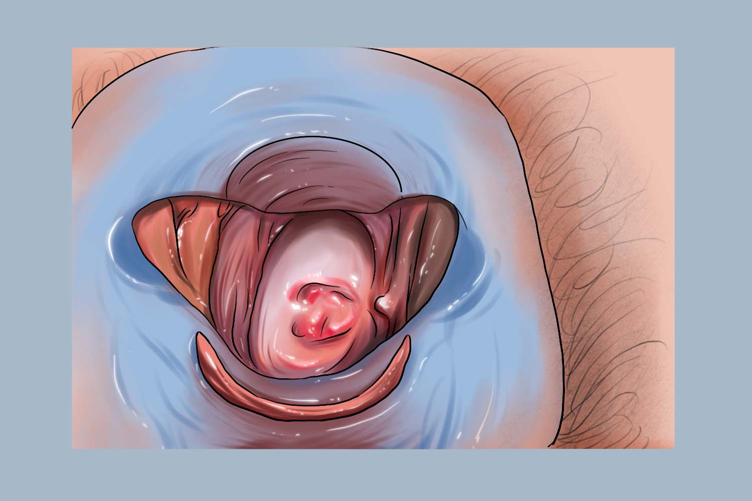 尿道肉阜出血图