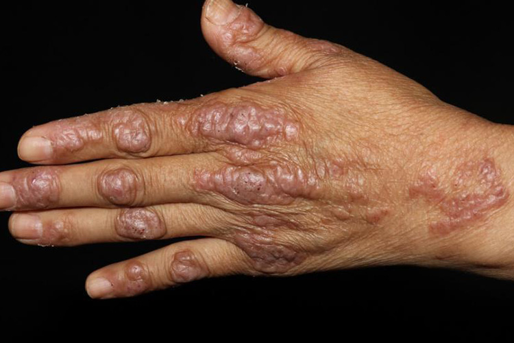 持久性色素异常红斑图