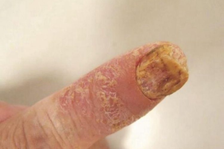 连续性肢端皮炎手指甲增厚图