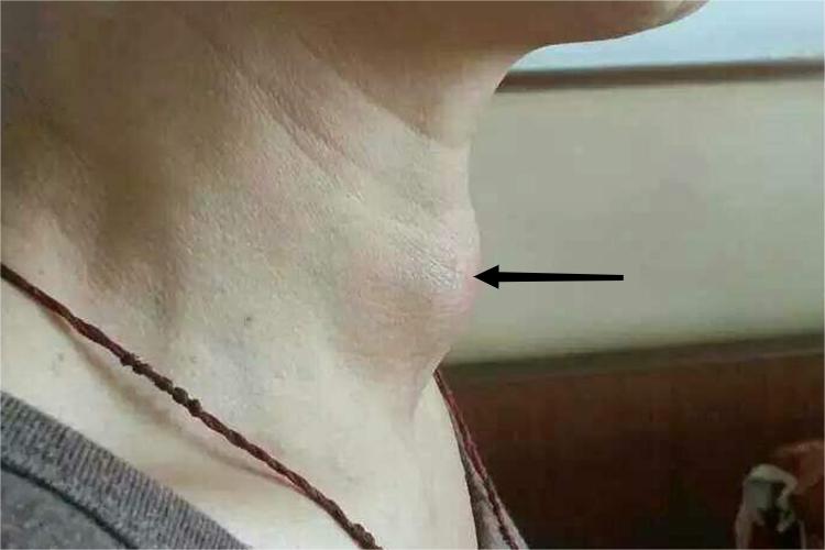 甲状腺良性肿瘤图