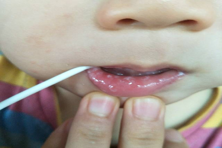 口腔念珠菌病嘴唇白色颗粒图