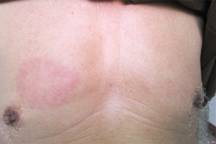 离心性环状红斑胸部红斑图 离心性环状红斑胸部红斑图