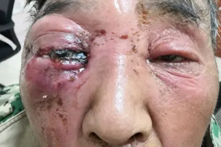 眶蜂窝织炎眼部症状图 眶蜂窝织炎眼部症状图