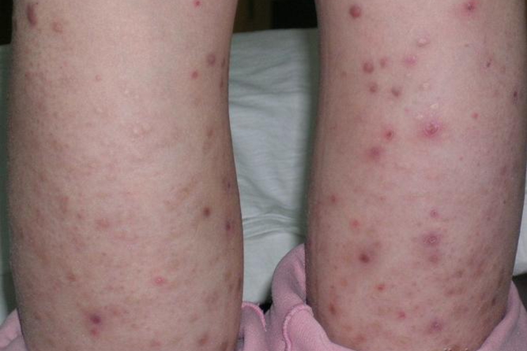 腿部苔藓样结核疹图 腿部苔藓样结核疹图