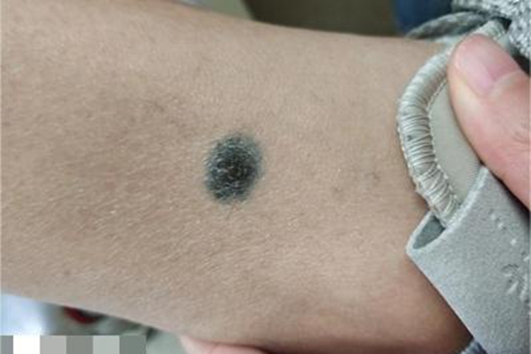 蓝色橡皮疱样痣小腿长痣图