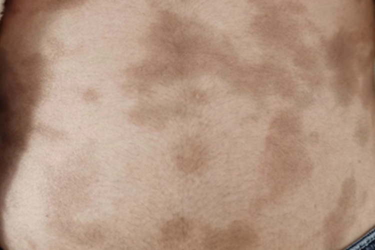 炎症后色素沉着肚子上长褐色斑图 炎症后色素沉着肚子上长褐色斑图