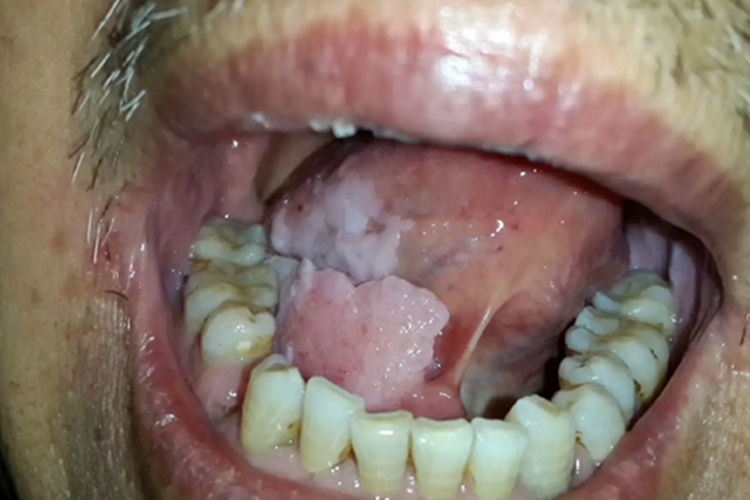 舌根乳头状瘤图