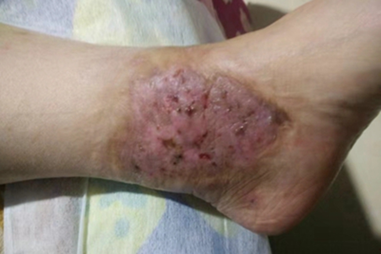 慢性湿疹脚踝皮肤增厚图