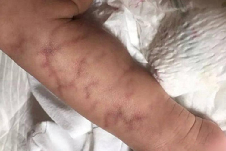 毛细血管扩张性大理石皮肤病斑图