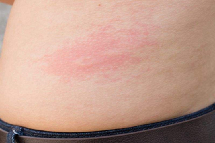 旋毛虫病腹部症状图