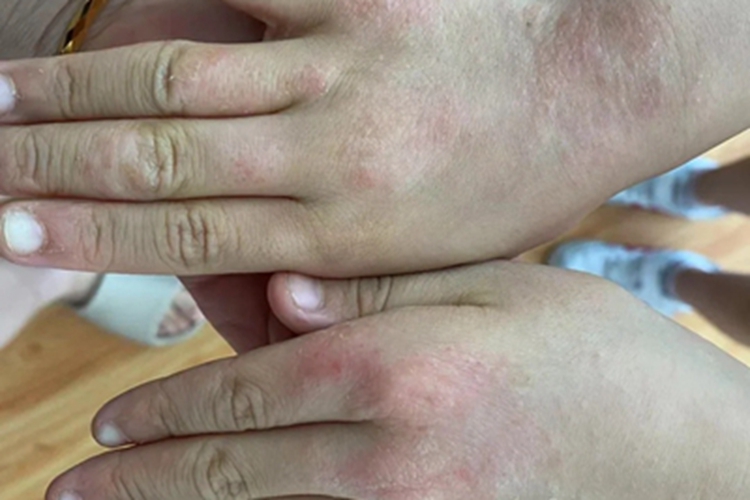 皮肤过敏红肿手背红斑图