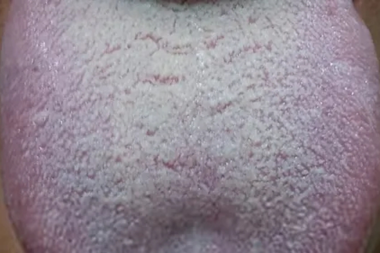 湿浊内停舌苔厚白图 湿浊内停舌苔厚白图