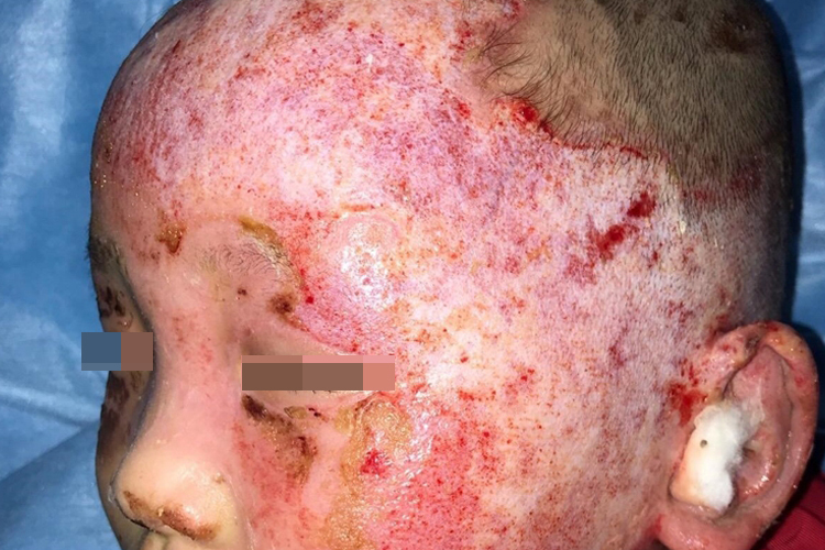 脸部深Ⅱ度烫伤图