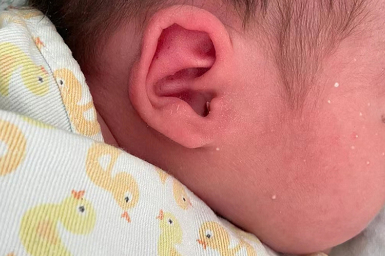 儿童面部粟丘疹图 儿童面部粟丘疹图