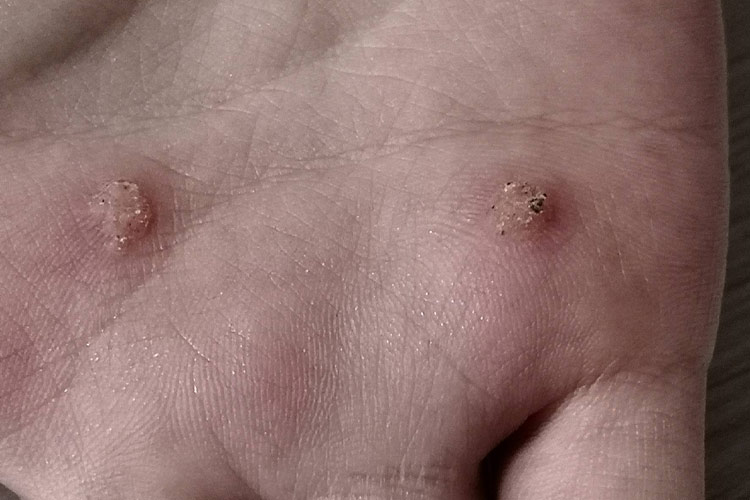 寻常疣手上丘疹图