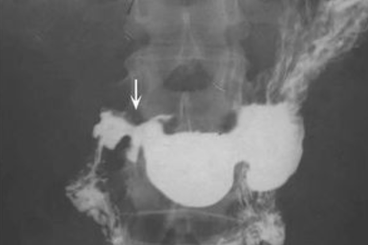 十二指肠溃疡造影图 十二指肠溃疡造影图