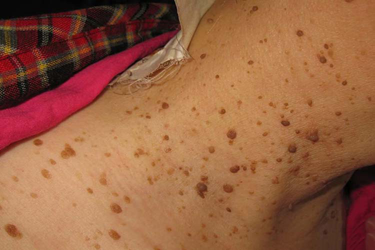 多发性皱纹状小丘疹图