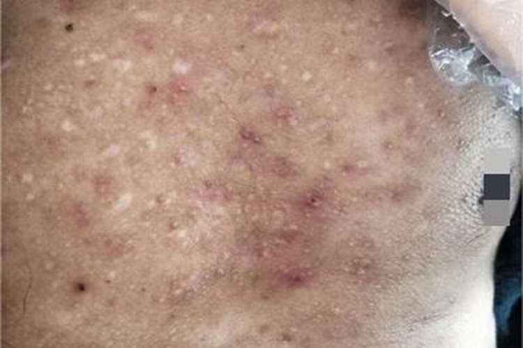 痤疮胸前出现很多斑片图