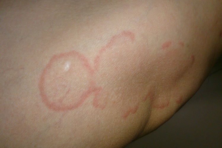匐行性回状红斑腘窝症状图