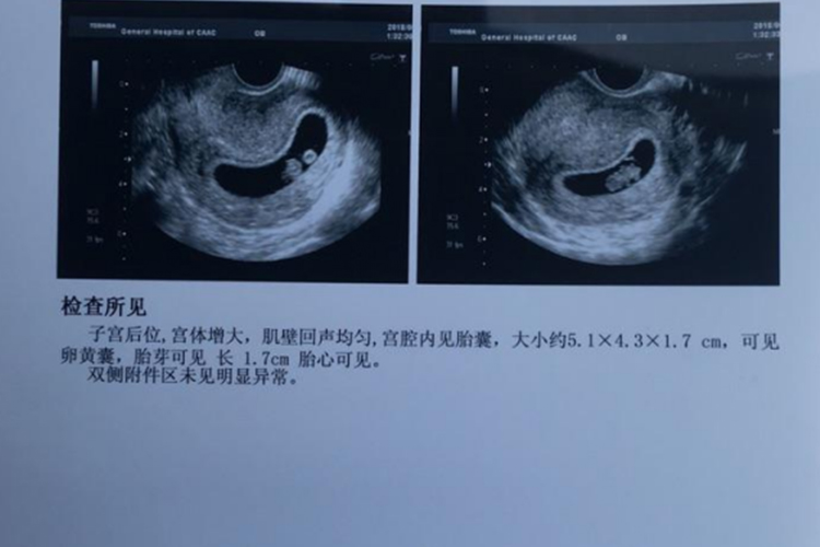 孕早期B超单图
