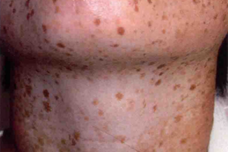 遗传性泛发性色素异常症颈部斑图