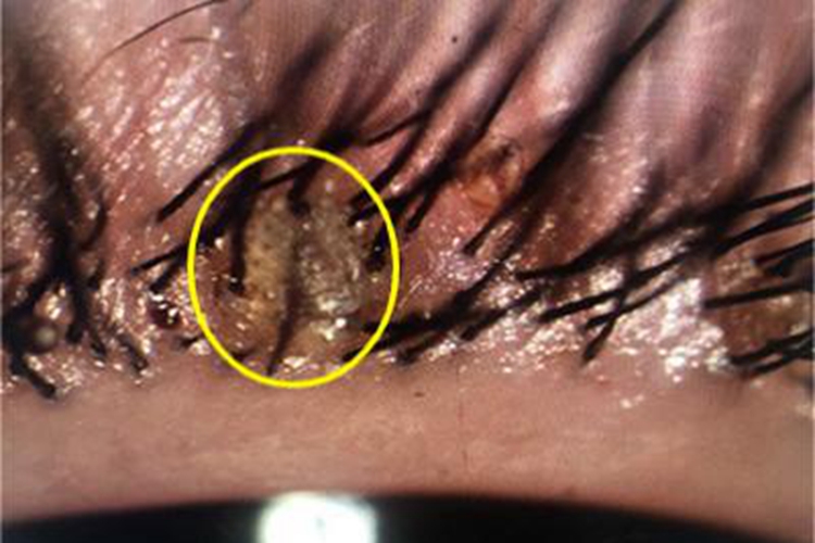 睫毛螨虫症状图片