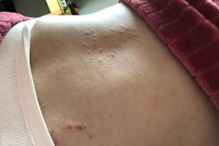 妊娠痒疹腰部丘疹图