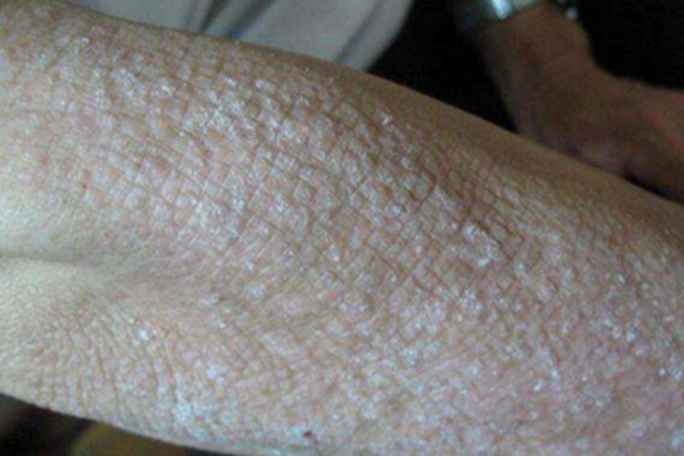 全身性瘙痒症胳膊皮肤粗糙图