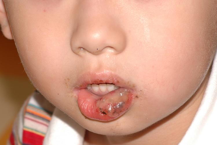 嘴唇被蟑螂咬后水疱图 嘴唇被蟑螂咬后水疱图