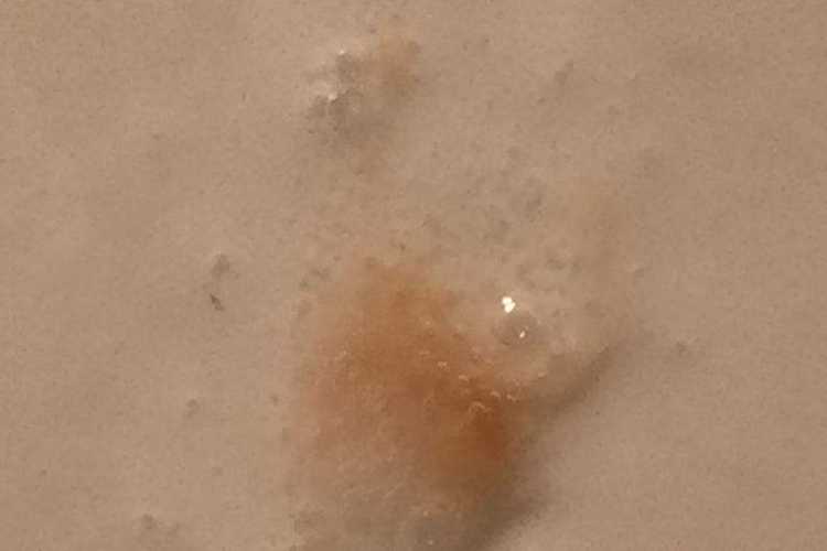 支气管炎痰液带血图